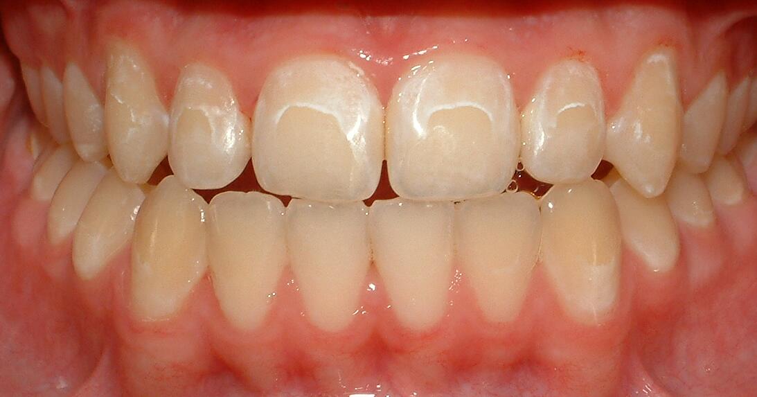 Front Teeth Gaps/Veneers Bolton, Ontario